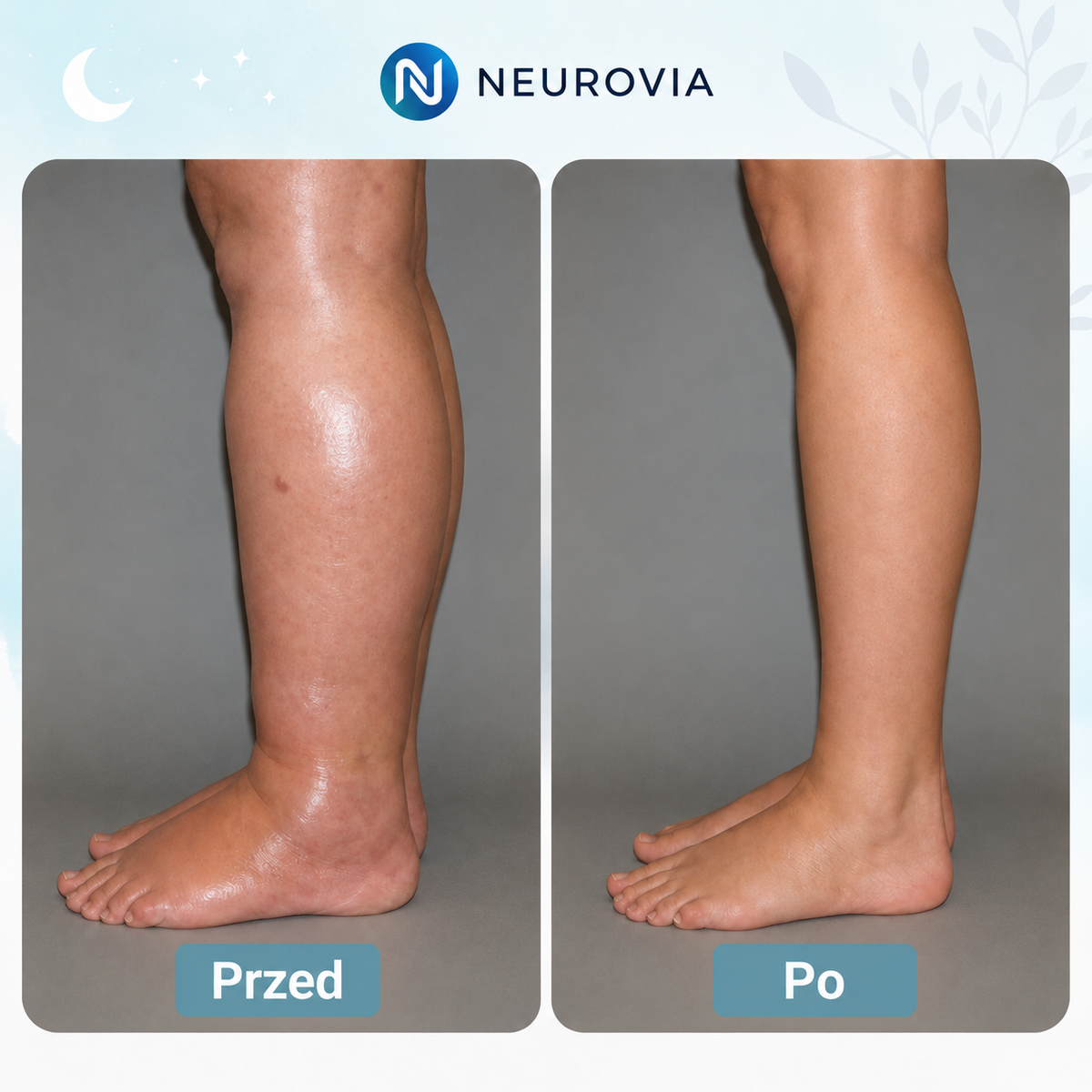 Neurovia™ Terapia EMS na opuchnięte, ciężkie lub osłabione nogi – do użytku domowego.